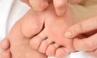 ۵ دلیل رایج پوسته پوسته‌شدن کف پا