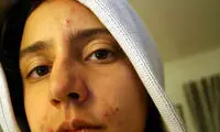 واکسن ضد جوش با بازار می آید