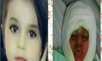 آخرین وضعیت دختر 3 ساله که در دیگ نذری افتاد