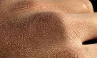 نحوه مراقبت از پوست‌های خشک در سرما