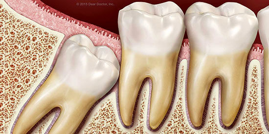 کشیدن دندان عقل موجب مرگ می‌شود؟