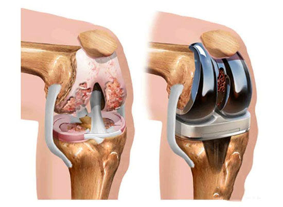 مزایا و معایب تعویض مفصل زانو