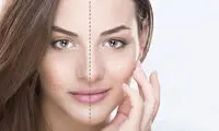 سابسیژن چیست و چگونه انجام می‌شود؟