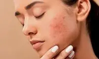 کشف جدیدی برای درمان جوش و آکنه