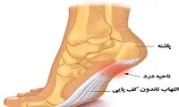 خار پاشنه را چگونه درمان کنیم؟