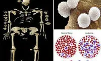 کشف قدیمی‌ترین مورد سرطان خون +عکس