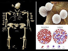 کشف قدیمی‌ترین مورد سرطان خون +عکس