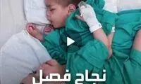 لحظه احساسی جداسازی دوقلوهای به هم چسبیده