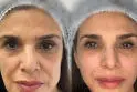 لیفت با نخ بهتر است یا اندولیفت؟ مقایسه این دو روش