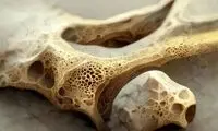 ابتلا به پوکی استخوان با مصرف خودسرانه این قرص