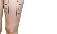 جراحی لیفت ران چیست و به چه روش هایی انجام می شود؟