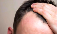 چه زمانی ریزش مو طبیعی نیست؟