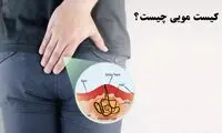 کیست پیلونیدال یا سینوس مویی چیست و چرا ایجاد می‌شود؟