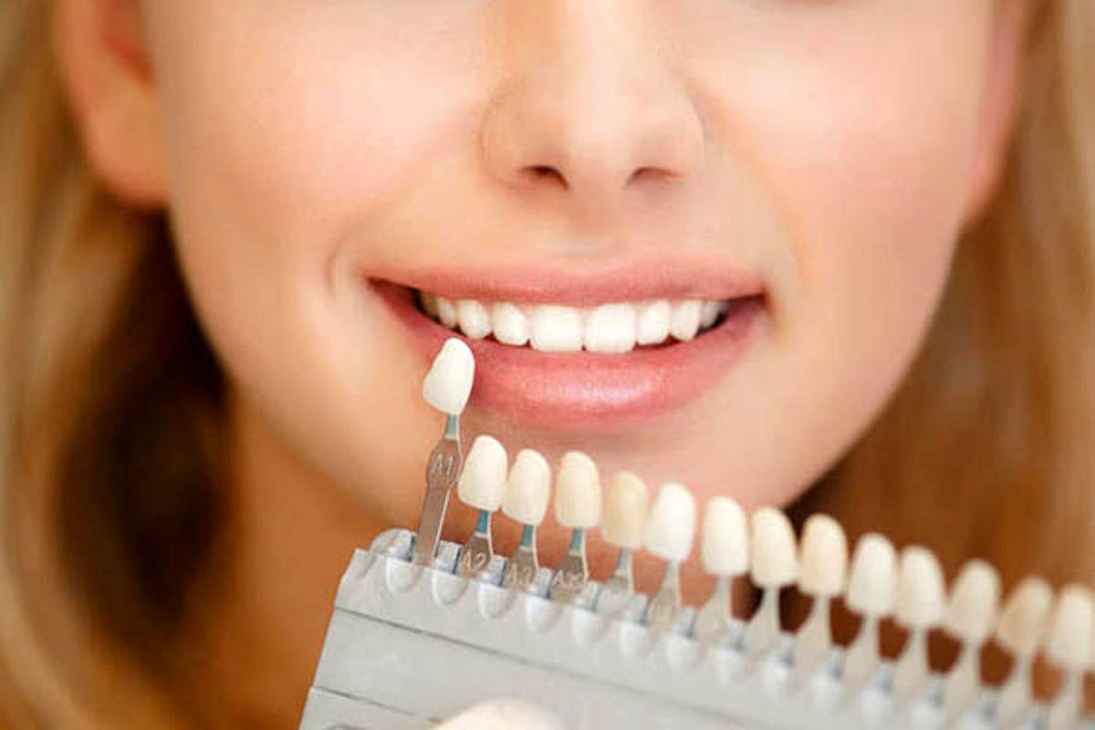   بررسی کامل مزایا و معایب لمینت دندان 