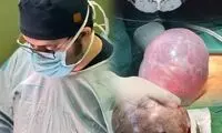 خارج کردن توده ۷ کیلویی از شکم بیمار آملی