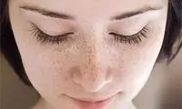 کمبود کدام ویتامین باعث لک صورت می‌شود؟