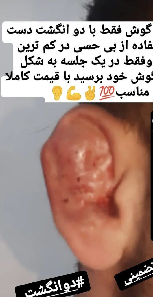 شکستن گوش در تهران چند؟