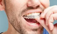 ارتودنسی بدون سیم و براکت چگونه انجام می شود؟