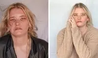 یک بیماری نادر، توان خندیدن را از این زن گرفت