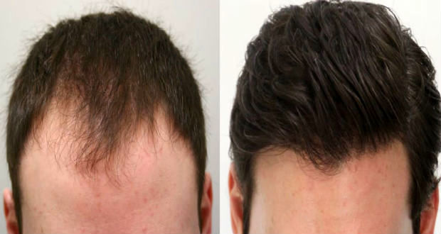 آشنایی با مراحل کاشت موی طبیعی از قبل تا بعد از عمل