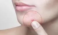 چرخه قاعدگی چه تاثیری بر پوست می‌گذارد؟