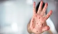 تائید مرگ سومین نفر در آمریکا به دلیل سرخک