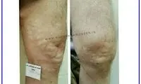 واریس پا را چه زمانی باید درمان کرد؟ علائمی که نباید نادیده بگیرید