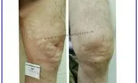 واریس پا را چه زمانی باید درمان کرد؟ علائمی که نباید نادیده بگیرید