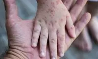طغیان سرخک در کشور همسایه