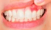 التهاب لثه چیست و چگونه درمان می‌شود؟