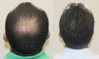 کاشت مو به روش sut چیست و چگونه انجام می شود؟