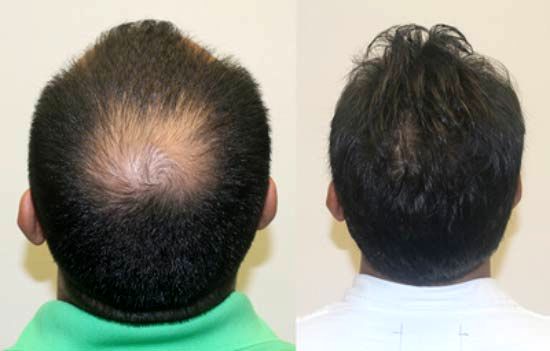 کاشت مو به روش sut چیست و چگونه انجام می شود؟