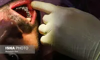 کاهش سن شیوع بی‌دندانی در ایران 
