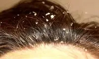 چطور از شر شوره سر رها شویم