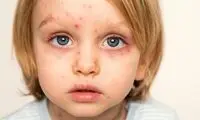 این گروه واکسن آبله‌مرغان بزنند