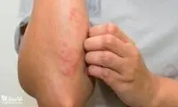 راهکاری برای کنترل اگزما در زمستان