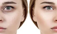  اندولیفت زیر چشم چیست و چه مزایایی دارد؟