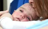 موفقیت جدید دانشمندان در مورد بیماری پروانه‌ای