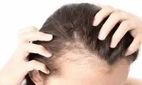 ۳ ماده خوراکی که باعث ریزش مو می‌شوند