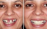 ایمپلنت دندان جلو چگونه انجام می‌شود؟ + مزایا و هزینه