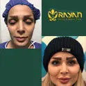 جدیدترین روش‌های تزریق چربی در سال 1404