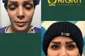 جدیدترین روش‌های تزریق چربی در سال 1404