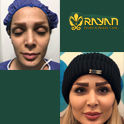 جدیدترین روش‌های تزریق چربی 1404