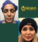 جدیدترین روش‌های تزریق چربی 1404
