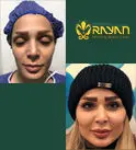 جدیدترین روش‌های تزریق چربی در سال 1404