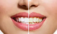 ترفند ساده برای رفع جرم دندان در 5 دقیقه!