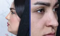 عمل جراحی بینی بدون بیهوشی (با بی‌حسی) چگونه انجام می‌شود؟
