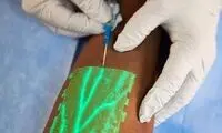 تکنولوژی خیره‌کننده برای دیدن رگ هنگام زدن آمپول