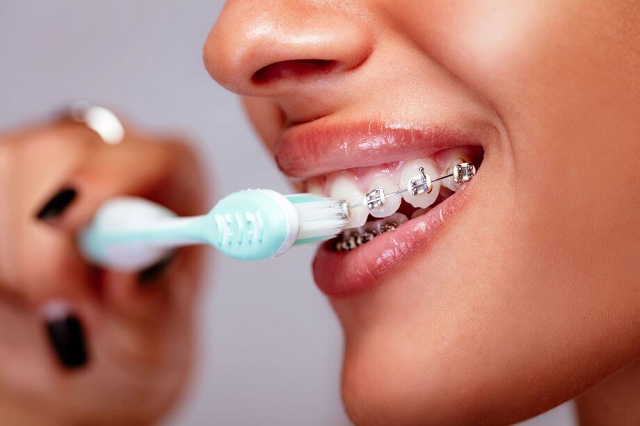 چگونه دندان های ارتودنسی را مسواک بزنیم؟