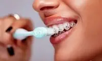 چگونه دندان های ارتودنسی را مسواک بزنیم؟